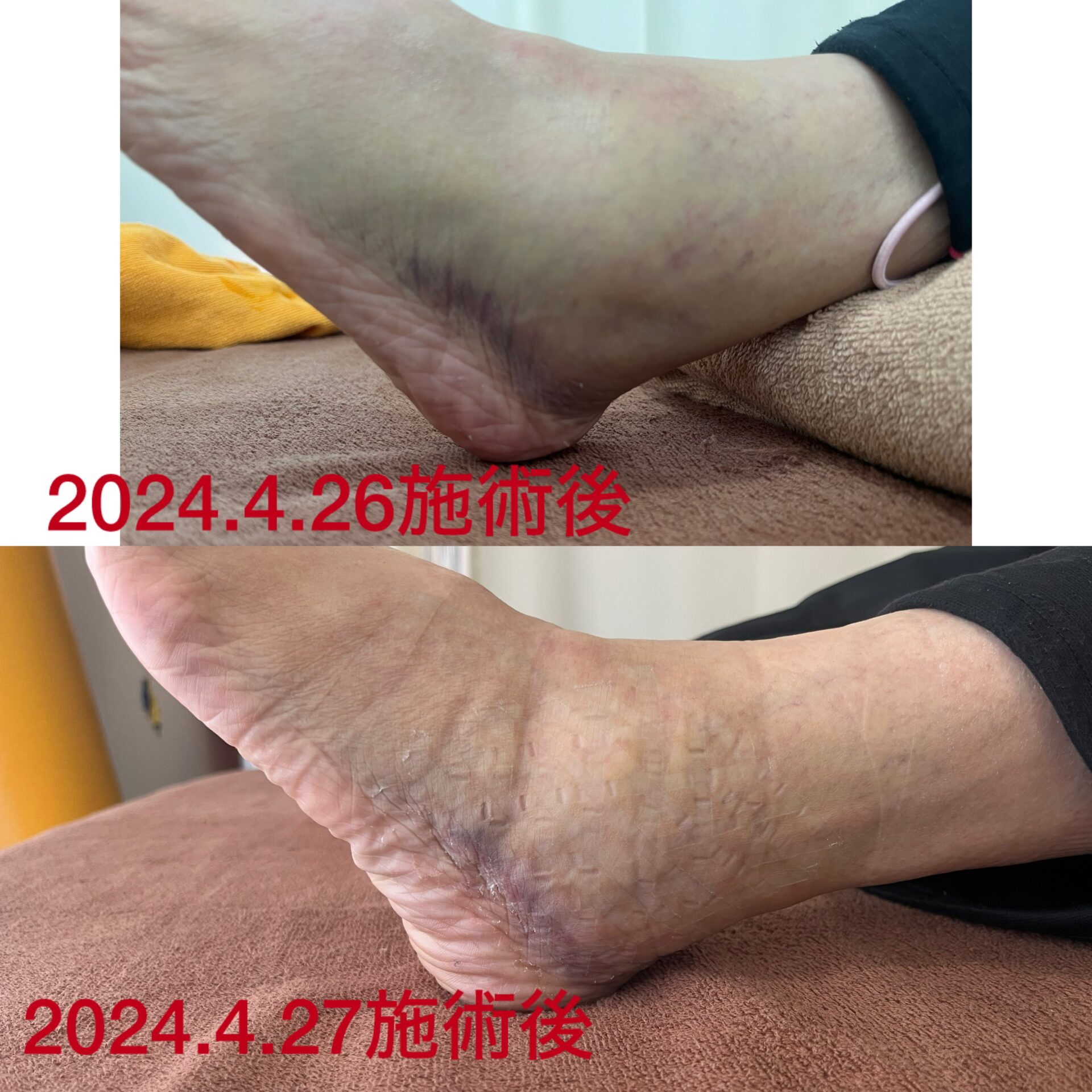 足関節捻挫治療 - 【公式】しゅん太鍼灸整骨院・整体院｜京都市北区の